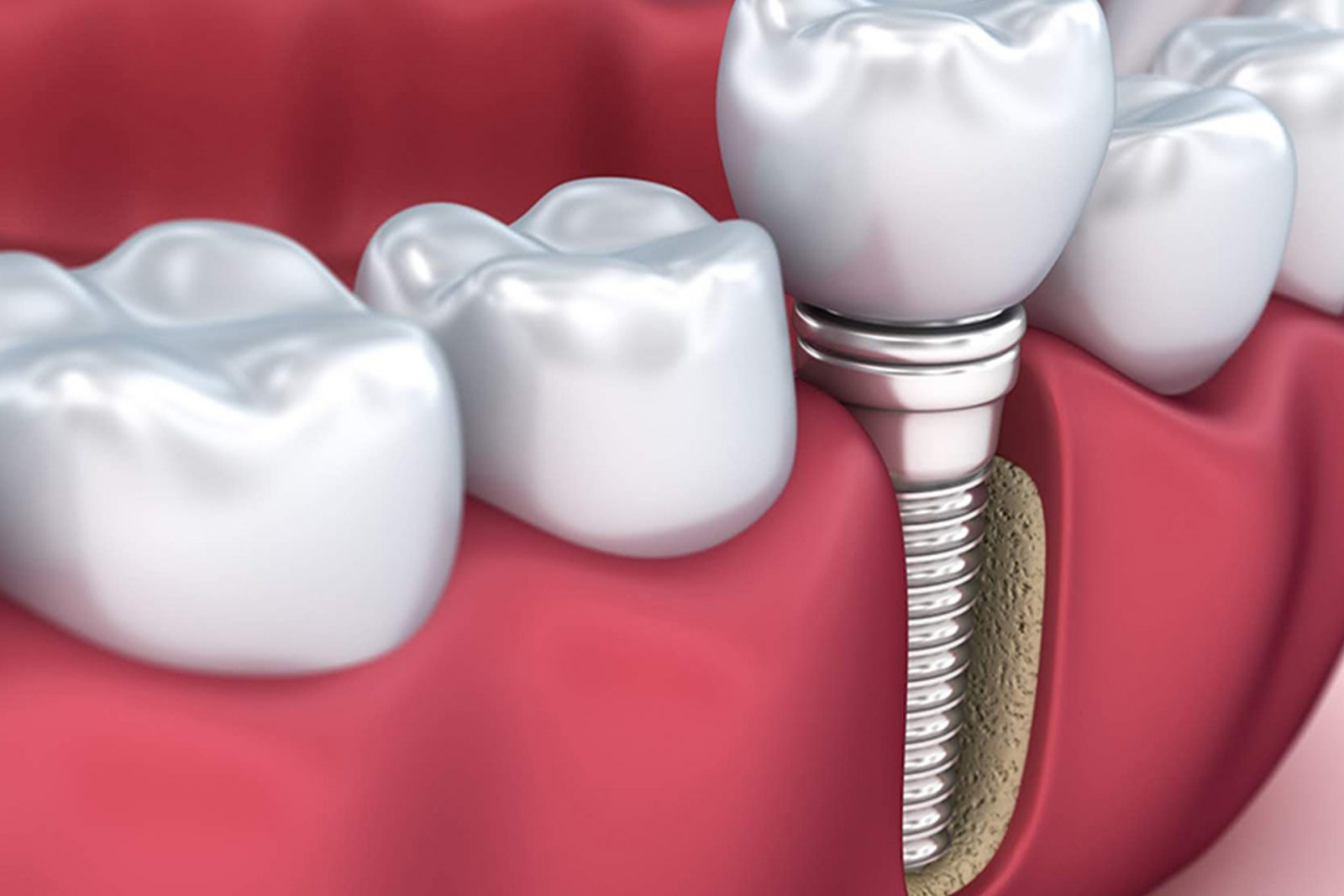 Хорошая клиника зубных имплантов